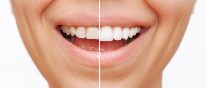 Veneers in Hildesheim