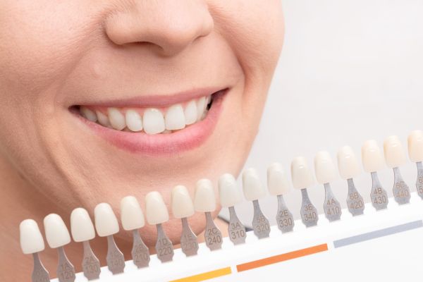 Zahnbleaching in Hildesheim mit dem In-Office Bleaching von Lydenti