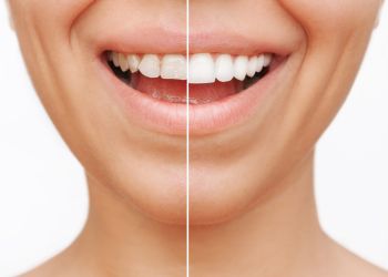 Veneers in Hildesheim
