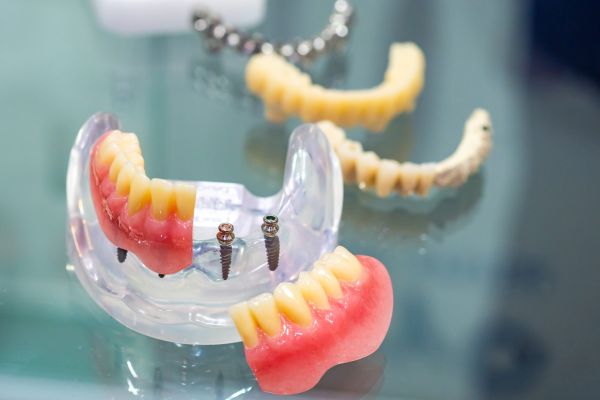 Miniimplantate Hildesheim