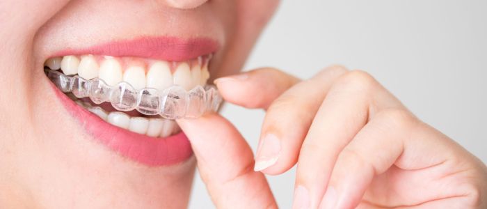Zahnkorrektur mit Invisalign in Hildesheim