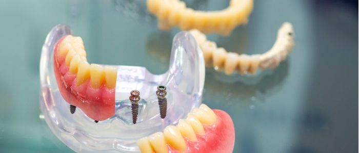 Miniimplantate Hildesheim