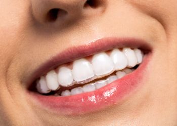Alignertherapie Hildesheim - Kieferorthopädie für Erwachsene