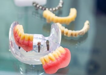 Miniimplantate Hildesheim – die kleinste Lösung für die Kiefer unserer Patienten