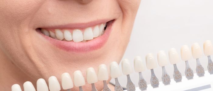 Bleaching in Hildesheim mit dem In-Office Bleaching von Lydenti