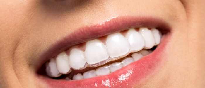Alignertherapie Hildesheim - Kieferorthopädie für Erwachsene